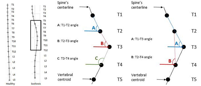 Chart comparing healthy and scoliotic spine curvature with vertebral angles marked.