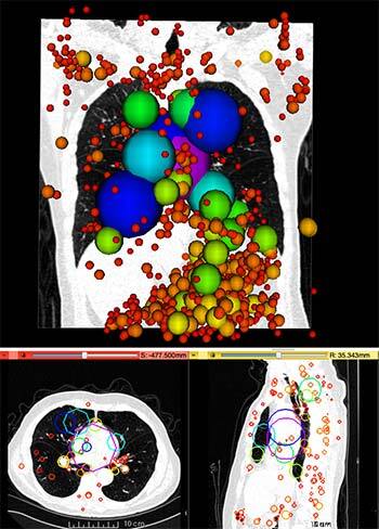 "Advanced CT scan analysis of lung nodules with colored overlays for educational demonstration."