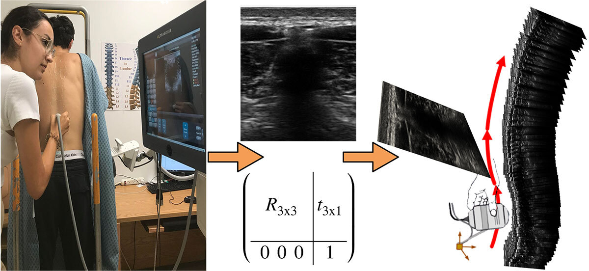 Spinal ultrasound sequence acquisition using freehand 3D ultrasound