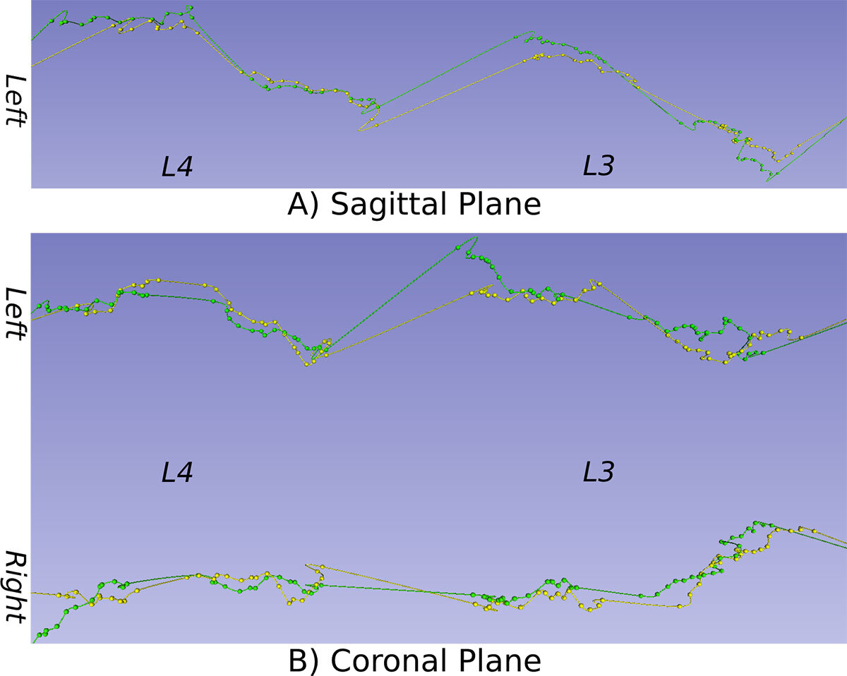 3D lamina curve extraction comparison, sagittal et coronal planes