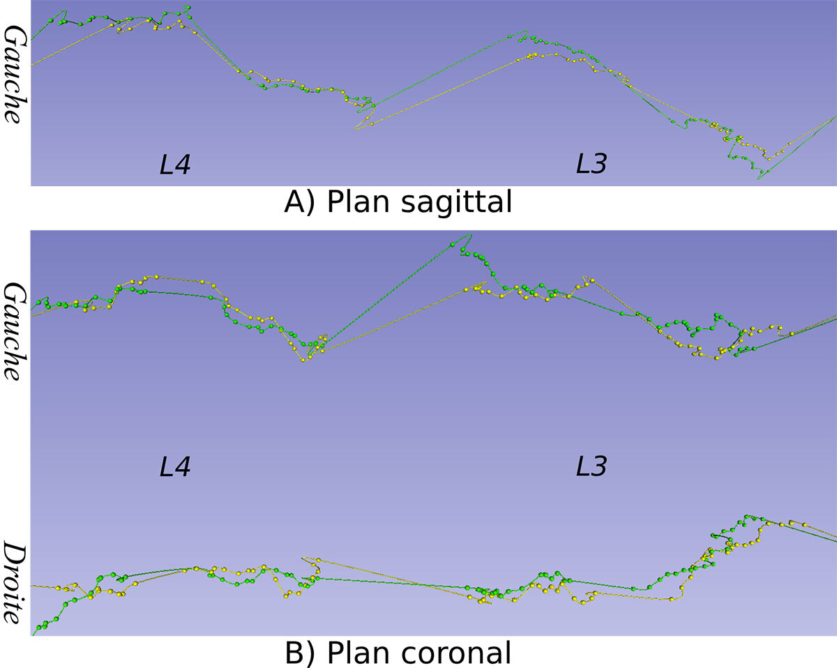 Comparaison de l’extraction 3D des courbes laminaires, plan sagittal et coronal